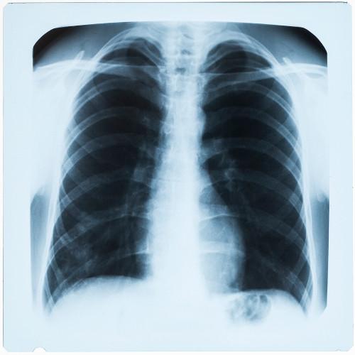 Domainex is developing new disease modifying treatments for COPD